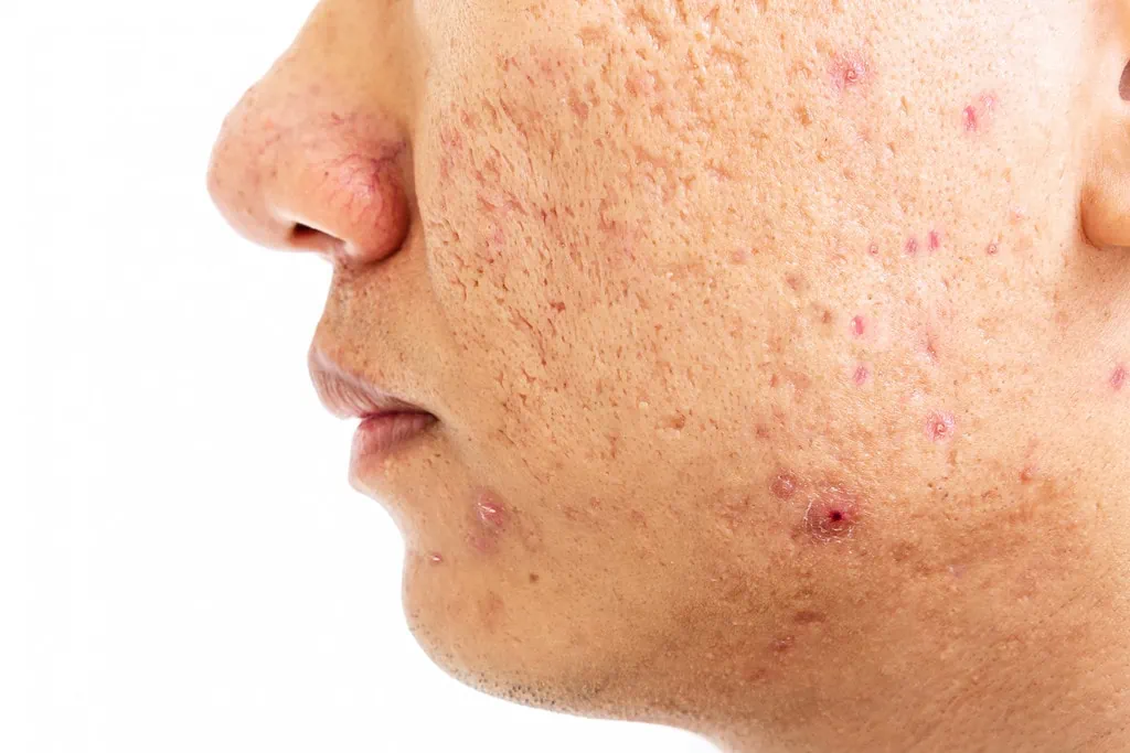 Close-up of facial skin with active acne, red blemishes, and acne scars.
